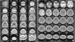 Metachronous intracranial meningiomas without dural attachment in a child - Rare case report and review of literature.