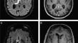 Multinodular and vacuolating neuronal tumor in the thalamus: case report and systematic review of literature.