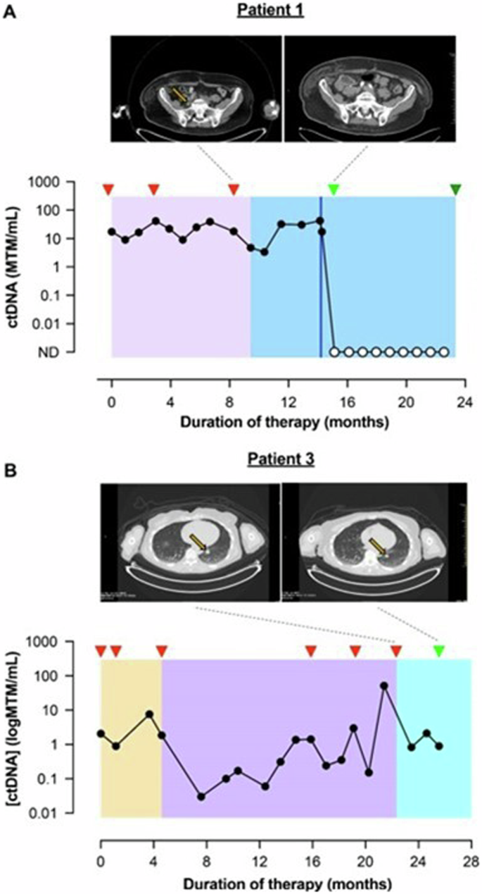 Efficacy of PARP inhibitor therapy after targeted BRAF/MEK failure in advanced melanoma