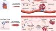 Critical hematological parameters in bleeding during extracorporeal membrane oxygenation support.