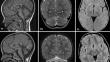 Phenotypic Spectrum and Natural History of Gillespie Syndrome. An Updated Literature Review with 2 New Cases.