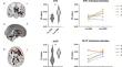 Structural connectivity modifications following deep brain stimulation of the subcallosal cingulate and nucleus accumbens in severe anorexia nervosa