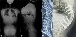 Is deformity correction essential in a "Myelopathic Cord"? - A case series.