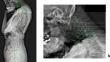 Radiological features of dropped head syndrome