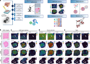 Spatial transcriptomic analysis of primary and metastatic pancreatic cancers highlights tumor microenvironmental heterogeneity