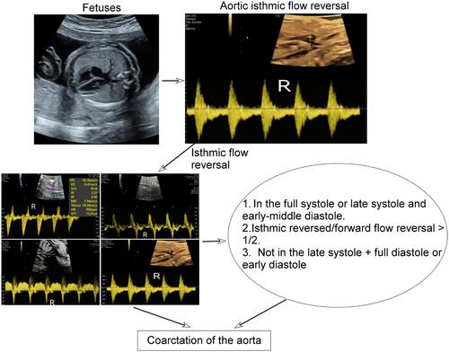 Aortic isthmus flow reversal in fetal coarctation of the aorta and the associated factors