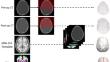 Dura-based automated vault expansion remodelling (DAVE-R): automated planning of volume expansion in fronto-orbital advancement for trigonocephaly