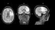 A clinical diary and timeline to monitor joint therapy for Apraxia of Speech and Aphasia