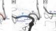 Anatomical investigation of the morphometry of the cerebral arteries using digital subtraction angiography in the Thai population