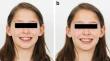 Effect of various active reminders via mobile phone on cooperation of orthodontic teenage patients regarding oral hygiene and Class II elastics use