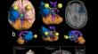 Early clinico-radiological outcomes following neuroendoscopic cysto-cisternostomy for middle cranial fossa arachnoid cysts: a prospective cohort study with illustrative cases