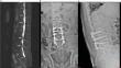 Lumbar fusion efficacy with local bone grafting and platelet-rich plasma: a clinical investigation in treating degenerative lumbar spinal stenosis in the elderly