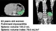 Impact of the spleen size on short-term prognosis in patients with cardiogenic shock receiving Impella-incorporated temporary mechanical circulatory support