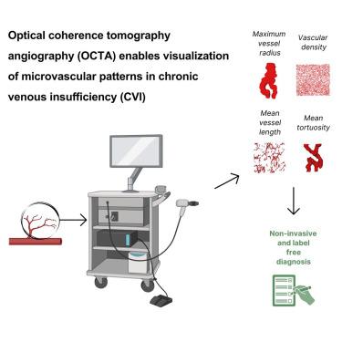 Optical coherence tomography angiography enables visualization of microvascular patterns in chronic venous insufficiency