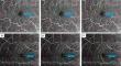 The role of Perifoveal Arteriolar Tortuosity in Optical Coherence Tomography Angiography (OCTA) images as an early indicator of hypertensive retinopathy