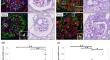 Aberrant localization of β1 integrin in podocyte cytoplasm of primary FSGS with cellular lesion