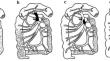 Clinico-Radiological Features of Acute and Chronic Superior Mesenteric Artery Occlusion (SMAO)