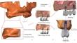 Biomechanical Performance of Different Implant Spacings and Placement Angles in Partial Fixed Denture Prosthesis Restorations: A Finite Element Analysis