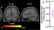 Static and temporal dynamic alterations of local functional connectivity in chronic insomnia