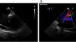 Laparoscopic cholecystectomy in a patient with Fontan circulation