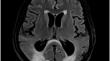 Posterior reversible encephalopathy syndrome and parkinsonism as the first manifestation of primary hyperparathyroidism - a report of two cases