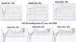 How differ eCAP types in cochlear implants users with and without inner ear malformations: amplitude growth function, spread of excitation, refractory recovery function