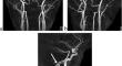 V3 segment of the right vertebral artery taking an anomalous posterosuperior course and penetrating occipital bone (wall of the jugular foramen) diagnosed by magnetic resonance angiography