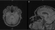 CACNA1G Causes Dominantly Inherited Myoclonus-Ataxia with Intellectual Disability: A Case Report