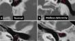 Imaging findings of isolated congenital middle ear malformation on high-resolution computed tomography