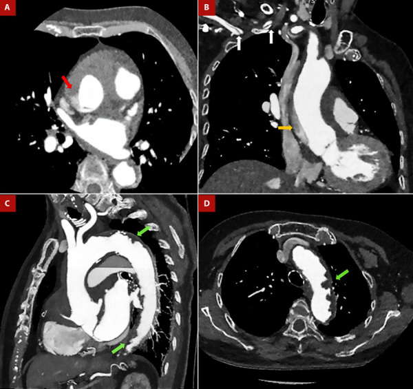 Shaggy aorta: ideal substrate for disaster. Updated review.