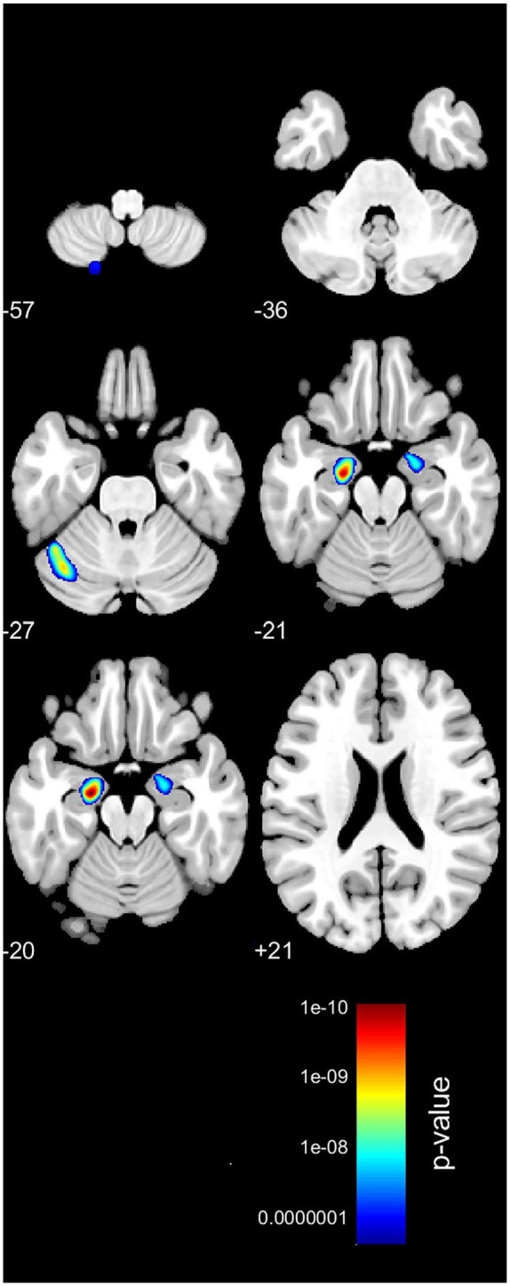 Neurostructural Consequences of Obstetric Brachial Plexus Palsy in Childhood.
