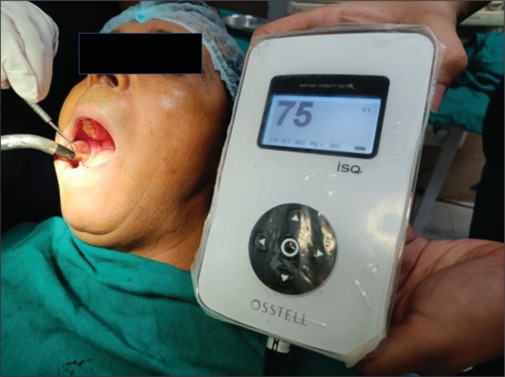 Comparative evaluation of submerged versus nonsubmerged dental implants - A prospective, clinico-radiographic, split-mouth study.