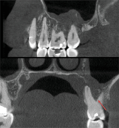 When Maxillofacial CBCT Permits Fortuitously to Diagnose Primary Non-Hodgkin's Lymphoma: A Case Report.