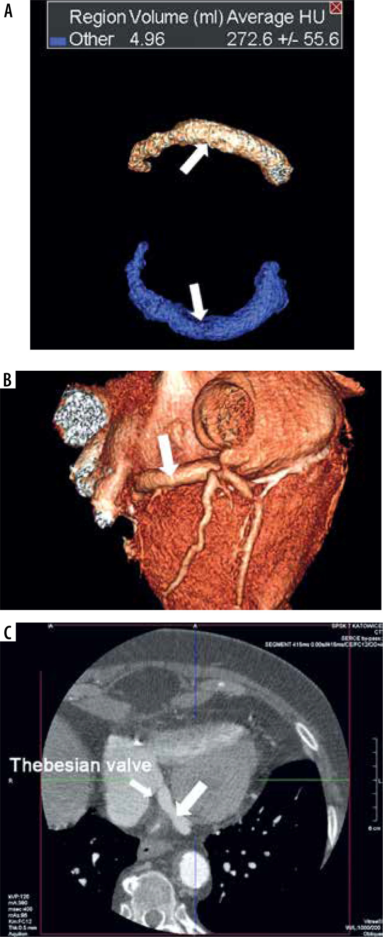 Possibility to measure the volume of coronary sinus in contrast-enhanced computed tomography.