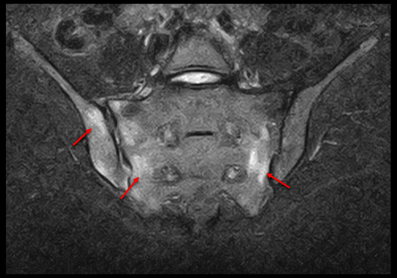 Coexisting Sacroiliac Arthritis and Chronic Nonbacterial Osteomyelitis in an Adolescent with Ehlers-Danlos Syndrome: A Case Report and Treatment Success.