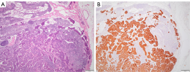 Collision tumor of the cecum and ileocecal valve composed of mucinous adenocarcinoma and neuroendocrine tumor: a case report.