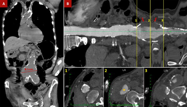 Shaggy aorta: ideal substrate for disaster. Updated review.