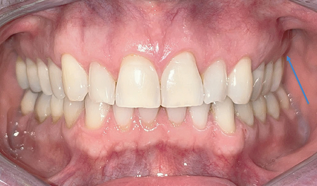 When Maxillofacial CBCT Permits Fortuitously to Diagnose Primary Non-Hodgkin's Lymphoma: A Case Report.