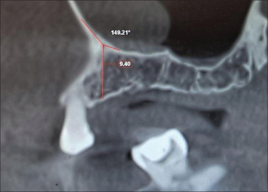 Cone-beam computed tomography assessment of palatal-nasal recess of maxillary sinus in dentulous and edentulous subjects.