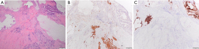 Collision tumor of the cecum and ileocecal valve composed of mucinous adenocarcinoma and neuroendocrine tumor: a case report.