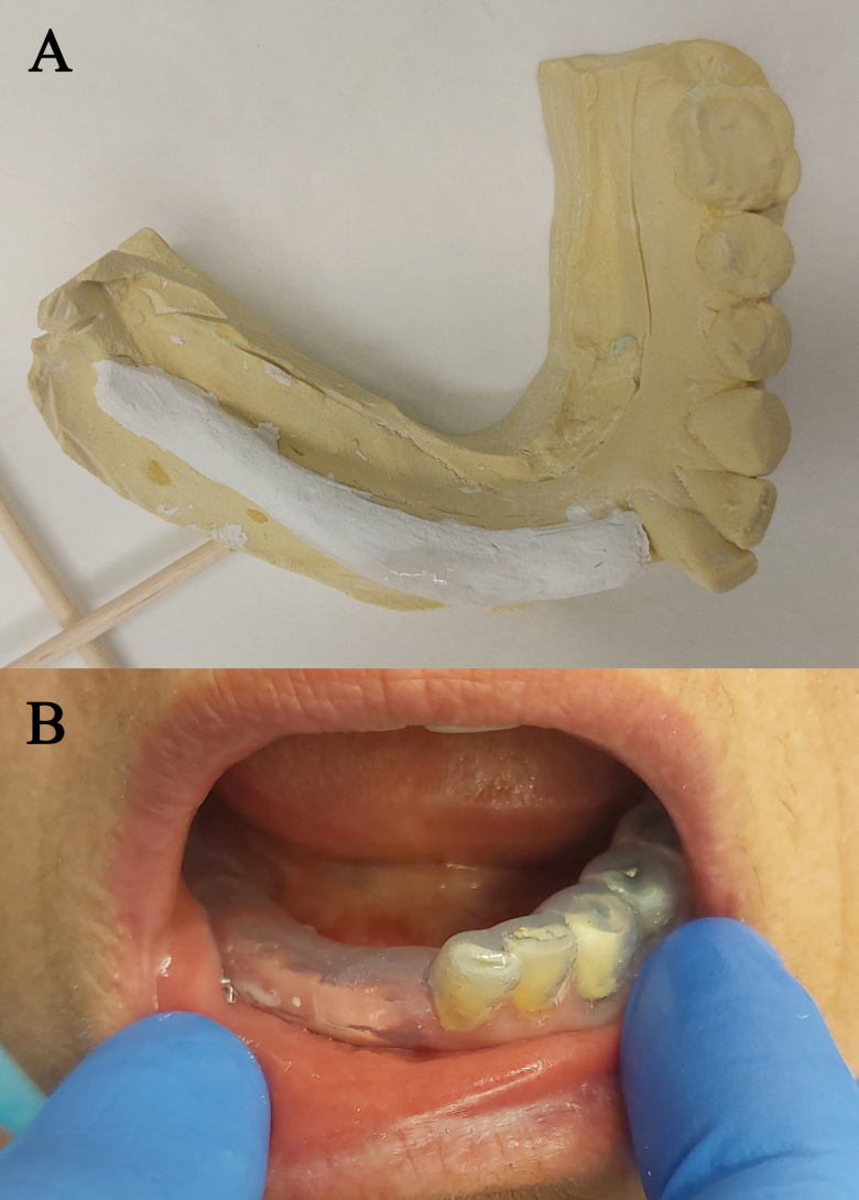 Various topical drug combination assessed using a neurosensory stent for chronic intraoral neuropathic pain: a pilot study.