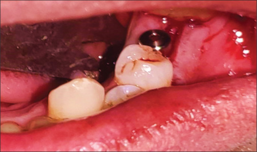 Comparative evaluation of submerged versus nonsubmerged dental implants - A prospective, clinico-radiographic, split-mouth study.