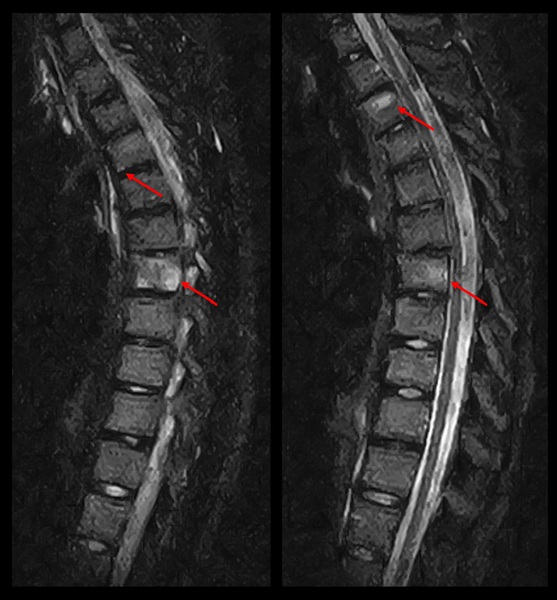 Coexisting Sacroiliac Arthritis and Chronic Nonbacterial Osteomyelitis in an Adolescent with Ehlers-Danlos Syndrome: A Case Report and Treatment Success.
