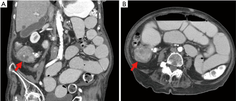 Collision tumor of the cecum and ileocecal valve composed of mucinous adenocarcinoma and neuroendocrine tumor: a case report.