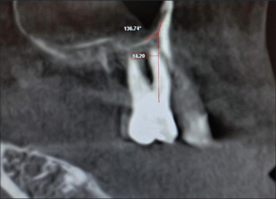 Cone-beam computed tomography assessment of palatal-nasal recess of maxillary sinus in dentulous and edentulous subjects.