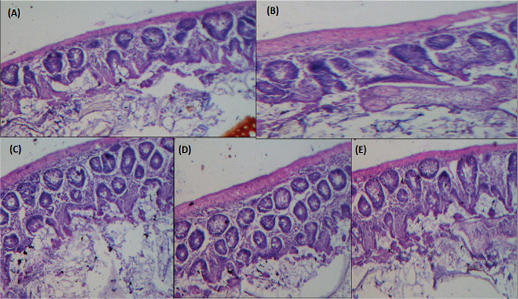 Development and Evaluation of Methotrexate and Baicalin-Loaded Nanolipid Carriers for Psoriasis Treatment.