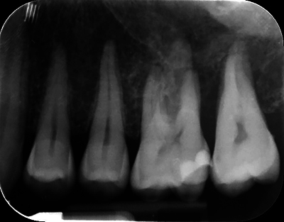 When Maxillofacial CBCT Permits Fortuitously to Diagnose Primary Non-Hodgkin's Lymphoma: A Case Report.