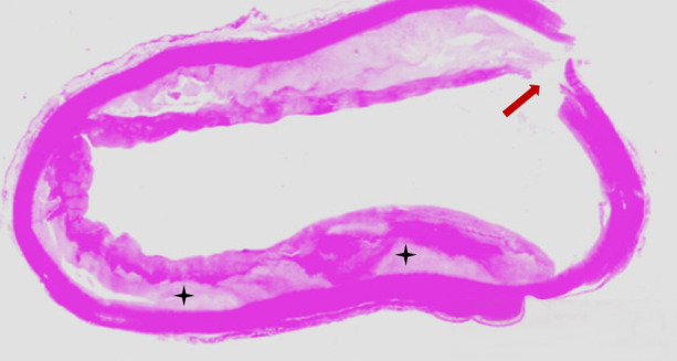 Shaggy aorta: ideal substrate for disaster. Updated review.