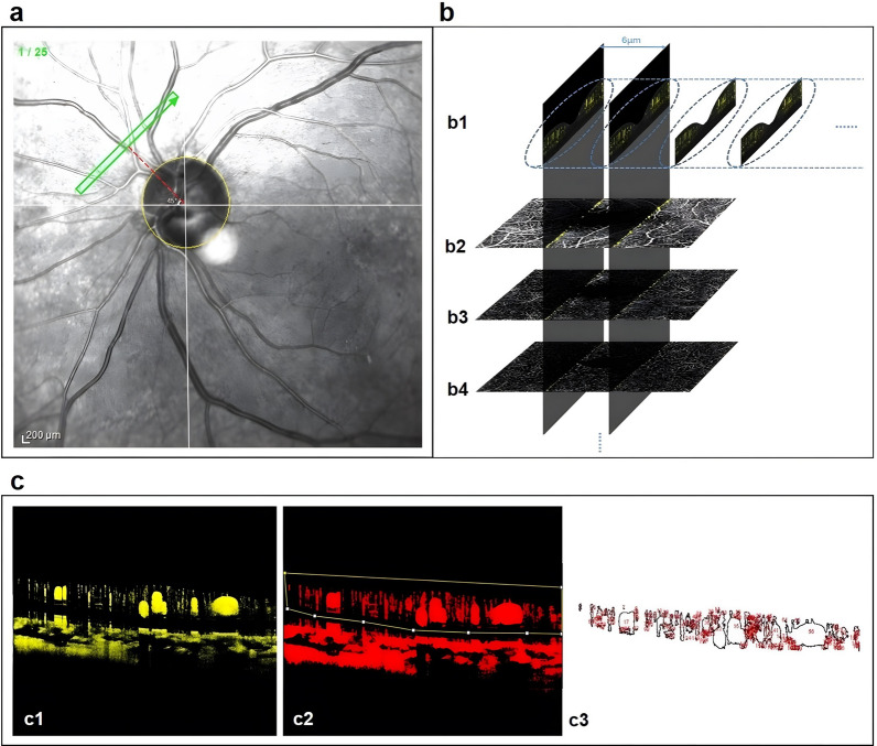 Quantitative analysis of peripapillary capillary volume using dense B-scan OCT angiography in normal and diabetic retina.