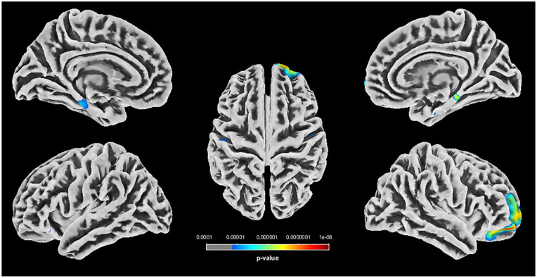 Neurostructural Consequences of Obstetric Brachial Plexus Palsy in Childhood.
